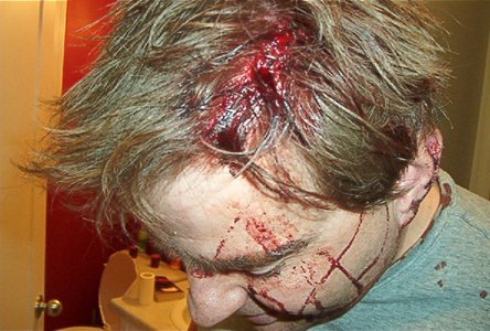 Robs Gaping Head Injury
url = family/rob.html
title = Robs Gaping Head Injury